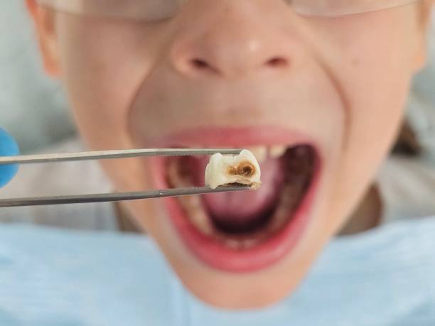 Best Emergency Wisdom Teeth Removal in Lake Holiday, VA